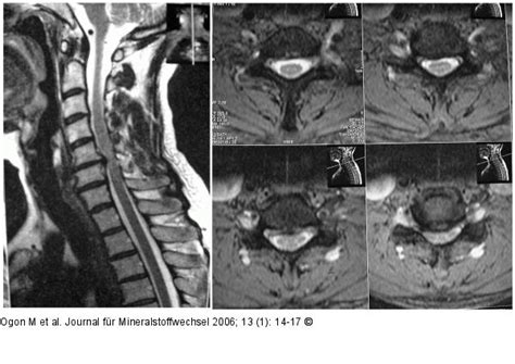 Mrt wirbelsäule (hws, bws, oder lws). Abbildung 3: Spondylose - Diskusprolaps