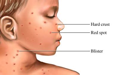 Chicken pox is given by airborne droplets (during conversation, coughing, sneezing). Primary Health Station: Chicken Pox: How Does It Looks Like?