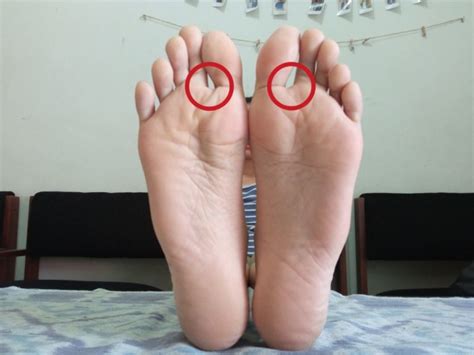 Plantar fasciitis adalah peradangan pada jaringan penghubung antar tulang (ligamen) rasa sakit pada tumit bervariasi dari ringan hingga berat, bahkan sampai bisa mengganggu pergerakan. 7 Titik Pijat Refleksi Kaki yang Bisa Dicoba Sendiri. Ampuh Redakan Mag Hingga Sakit Gigi