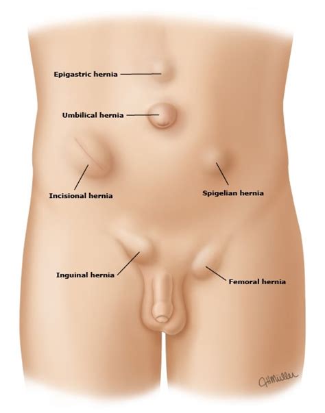 This age group is more prone to developing a hernia as the muscles wear off with age. What are Hernias | Hernia Surgery in Dubai