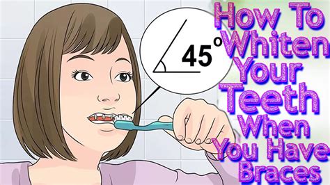 There are numerous ways to whiten your teeth overnight. How to Whiten Your Teeth when You Have Braces |How to ...