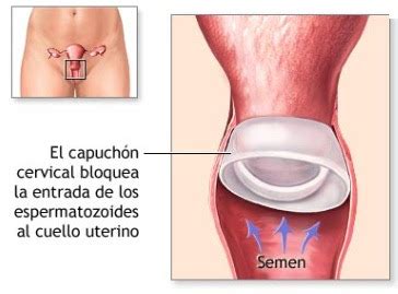 Amor, sexo, condon femenino, mujer, placer, sexo protegido. EDUCACIÓN SEXUAL : DIAFRAGMA
