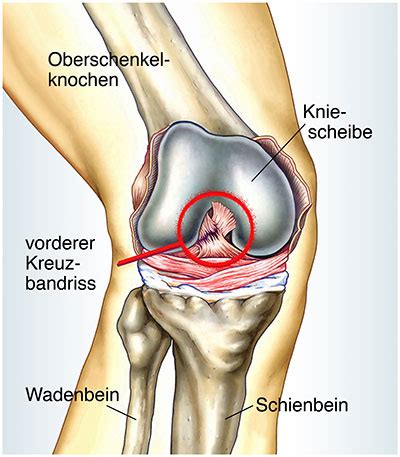 Denn schmerzen blockieren die muskulatur und würden bewegungen fast unmöglich machen. Vorderer Kreuzbandriss - Ursachen, Symptome & Behandlung ...