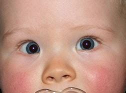 The epicanthic fold produces the eye shape characteristic of persons from central and eastern asia; Flat Nasal Bridge And Epicanthal Folds / An epicanthal ...