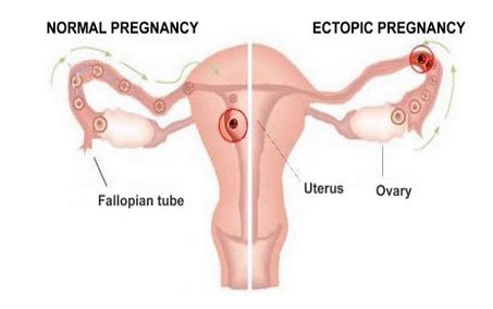 Ectopic pregnancy occurs when an embryo attaches outside the uterus, most commonly in the fallopian tubes. Ectopic Pregnancy Treatment Service in Nerul, Navi Mumbai ...