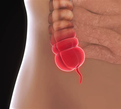 Mar 30, 2017 · what is an appendix? How to Tell If That Pain Is Your Appendix - Health Essentials from Cleveland Clinic