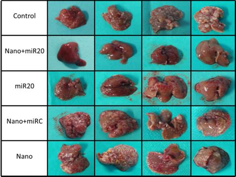 Pain is anticipated, and opioid narcotics, or very strong pain medicines. MicroRNA-loaded nanoparticles against liver metastasis ...