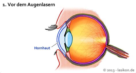 Beim augen lasern trägt der arzt mithilfe eines lasers in sekundenschnelle gewebe am auge ab. Astigmatismus Lasern Kosten - Hypnotherapy to Lose Weight