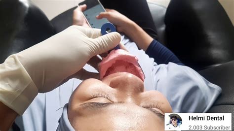 Pilihan untuk gigi palsu ada 2 jenis yaitu gigi tiruan lepasan dan gigi tiruan cekat bagian leher gigi yang terkikis akan membuat gusi turun, dan enamel serta sebagian akar gigi. membuat gigi palsu bagian atas - YouTube