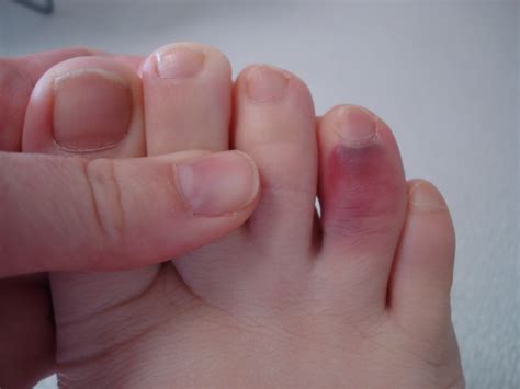 Maybe you would like to learn more about one of these? Bruised 4th toe (91/365) | I managed to trip over shoes I ...
