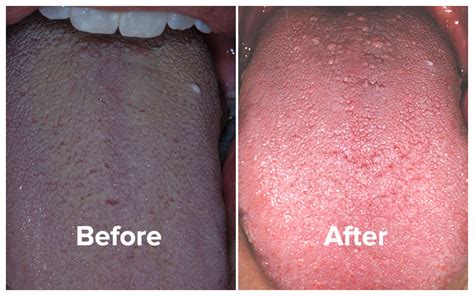 83940) explains the importance of cleaning the tongue. How To Effectively Clean Your Mouth & Eliminate Bad Breath ...