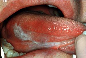 Tongue cancer is a type of oral cancer or mouth cancer characterized by a malignant transformation of the cells that make up the tongue. Cancer Pictures - Cancer of the Mouth, Lip & Tongue ...