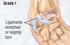 With the moderate grade ii mcl tear, ligament tears partially. Patient Basics: Ankle Sprain | 2 Minute Medicine