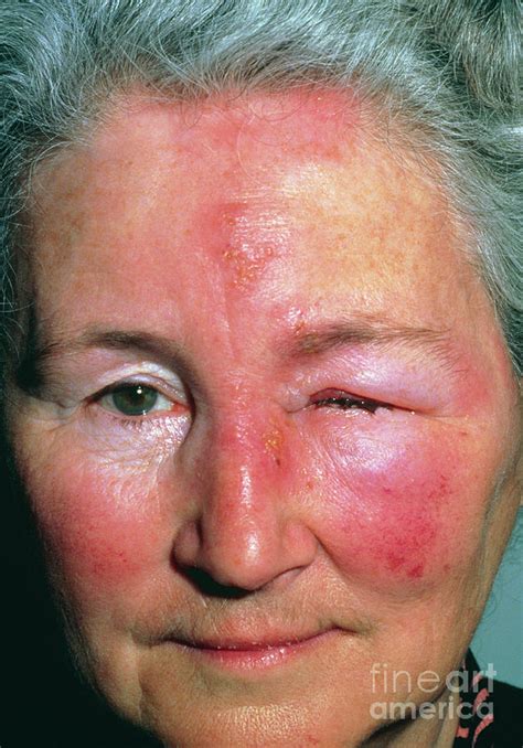 Herpes Zoster (shingles) Affecting Nerve Of Face Photograph by Dr H.c ...