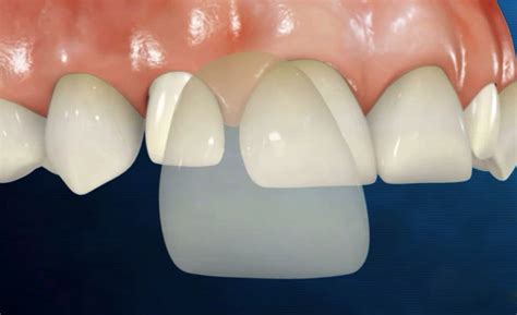 Check spelling or type a new query. Understanding Veneers and Cosmetic Dentistry | Port ...