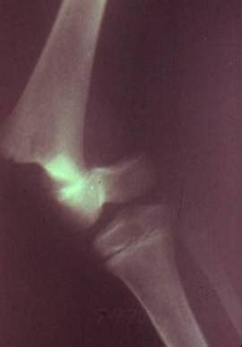 Chapter 80 distal femur fractures eric m. Distal Femoral Physeal Fractures - Pediatric - Pediatrics ...