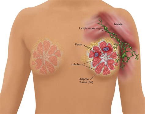 Breast cancer is most common in women, but men can get breast cancer, too. 20 Things to Know About DCIS, or 'Stage 0' Breast Cancer ...