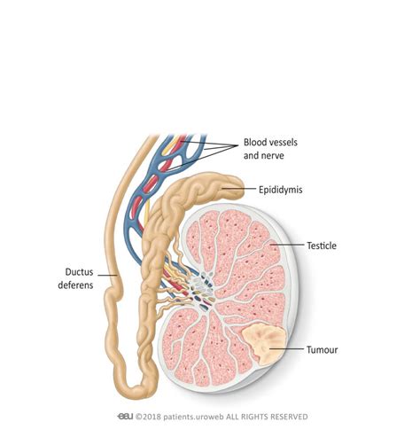 Testucular lump feels like a hard mass (if cancer is of concern). Testicular cancer - Patient Information