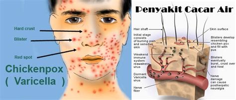 Paling best demam campak ini langsung tidak meninggalkan parut. Cara Hilangkan Parut Chicken Pox Dengan Berkesan | Idayu ...