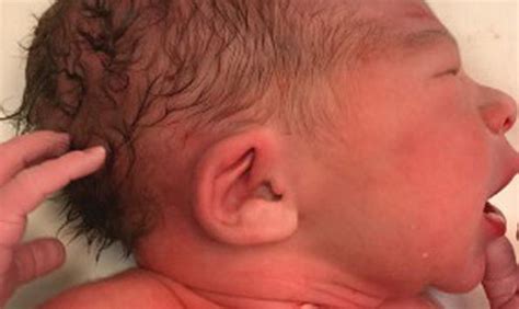 Complete trisomy 22 is a very rare condition and affected fetuses are almost always lost in the first trimester. Flat Nasal Bridge And Epicanthal Folds / Nasal Bridge ...