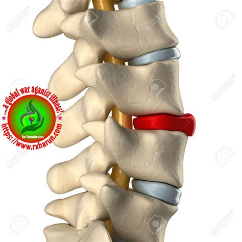 We did not find results for: C4 and C5 Disc Herniation - Causes, Symptoms, Treatment ...