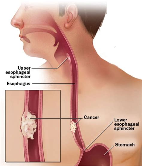 Throat cancer refers to cancerous tumours that develop in the throat, voice box or tonsils. Best HealthCare Portal | Appointments | Diagnosis ...