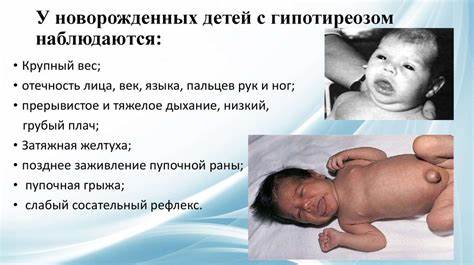 Гипотиреоз беременных. Врожденный гипотиреоз - презентация онлайн Картинка - Гипотиреоз беременных. Врожденный гипотиреоз - презентация онлайн