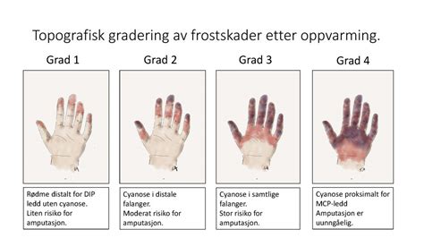 Behandlingen av overflatiske brannskader er også annerledes og enklere enn ved dype større brannskadar vert behandla som andre ulykker og vert tekne i mot direkte på sjukehus av eit. NY VÅR FOR BEHANDLING AV DYPE FROSTSKADER - Kirurgen