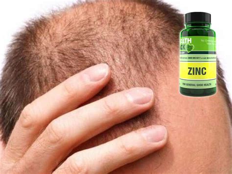 Using vitamins to combat hair loss. Should We Take Zinc For Hair Loss? Read This First!