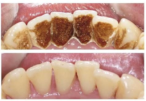 Because there's very little color or no color, they tend to pick up strongly tinted liquids and foods very. Pin on Dentistry