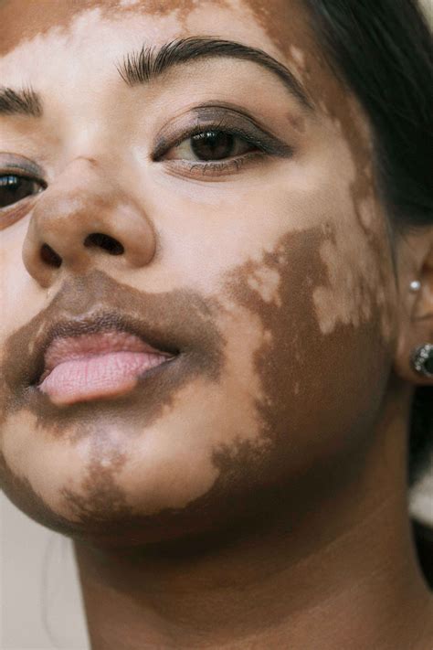 Vitiligo can affect any part of the body, and it can occur in people of any age, ethnicity, or sex. Elisabeth fotografeert vrouwen met vitiligo: 'Unieke ...