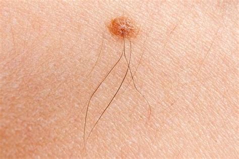 Feeling very tired or unwell. Signs That You May Have Skin Cancer