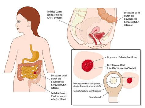 Bei zu heißem wasser kann es zu nachblutungen an den wunden kommen. Künstlicher Darmausgang - Anus praeter - Bauchafter - Stoma