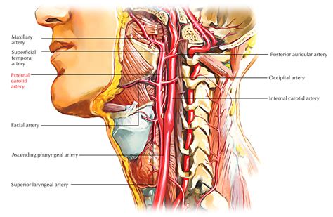 A carotid artery narrowed by fatty deposits from atherosclerosis (plaque buildups in artery walls) may become blocked by a blood clot. External Carotid Arteries - Earth's Lab