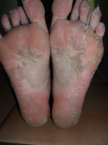 This can happen if your feet are constantly exposed and you do not wear closed. Dead Skin Acid Peel for your feet. (Kitchen Cabinet Remedy!)