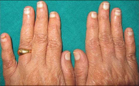 Abnormalities | leukonychia causes, symptoms leukonychia treatment for white spots on nails. Nail as a window of systemic diseases - ScienceOpen