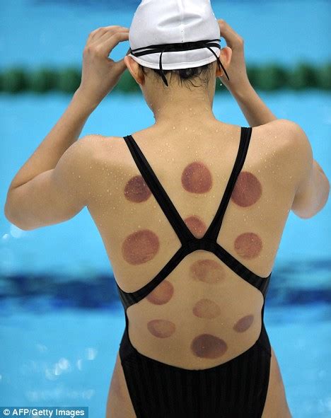 Download this free photo about cupping therapy of traditional chinese medicine, and discover more than 8 million professional stock photos on freepik. The price of Gold: Chinese athletes left with huge spots ...