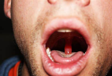 Enlarged Uvula Causes, Symptoms, and 8 Home Remedies To Manage