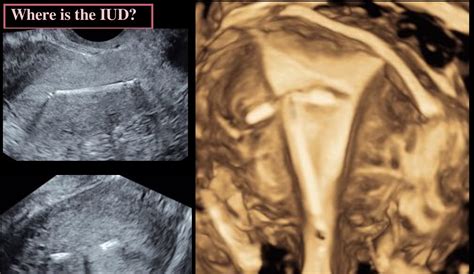 Maybe you would like to learn more about one of these? 3D Ultrasound in Gyn-Why it's Important | Sound Waves Image
