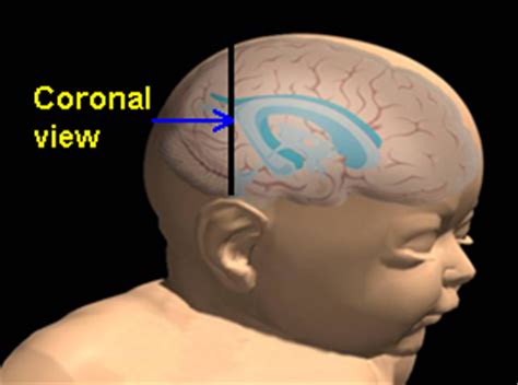 Transverse (coronal) sections rostral to caudal. CNS: Ultrasound Anatomy, Brain - OB Images - OB Images