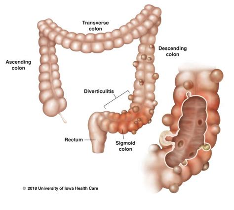 Colon cancer however is caused by small lumps that progress into cancerous tumors. Laparoscopic Colon Surgery, Diverticulitis, Colon Cancer ...