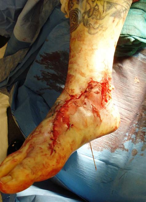 Degloving injury | The Foot and Ankle Online Journal