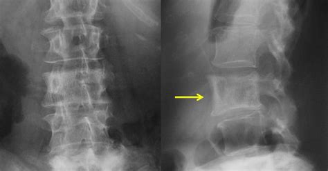 This sign can be seen in patients with paget disease. Dr. Pepe's Diploma Casebook: Case 5 - SOLVED! | Blog