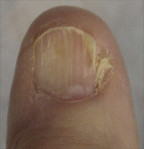 It is usually painless, but an advanced tumour invading underlying bone may cause severe pain. In Situ Amelanotic Melanoma of the Nail Unit Mimicking ...