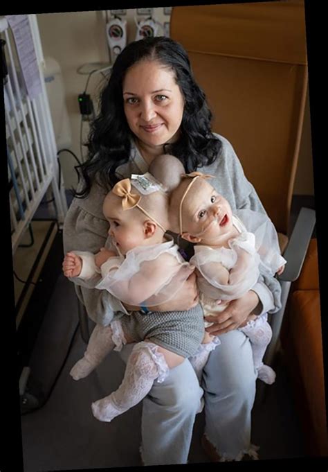 Famous conjoined twins at the head. 9-Month-Old Twins Conjoined at the Head Are Successfully ...