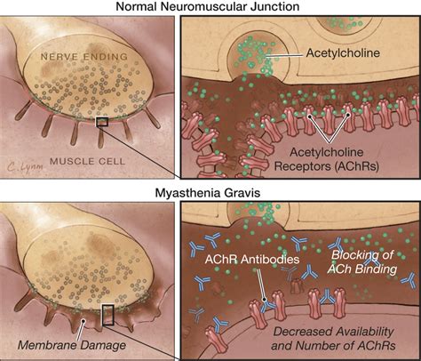 However, available treatments usually can control symptoms, allowing those diagnosed with the. Remdesivir In Myasthaenia Gravis : What is myasthenia gravis? - YouTube / However, the us food ...