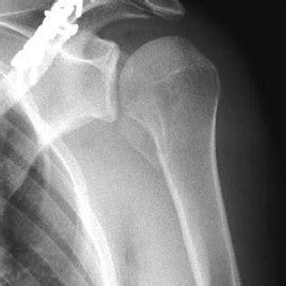 Proximal humerus greater tuberosity fracture with rotator cuff tear: (PDF) Combined displaced fracture of the lesser humeral ...