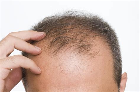 Others may cover it up with hairstyles, makeup, hats or scarves. Hair loss most common in summer, fall