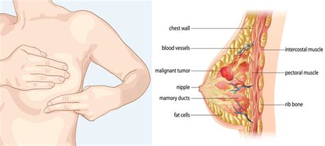Keep in mind that these symptoms can happen with other conditions that are not cancer. Breast Cancer Symptoms: Signs and Symptoms of Breast ...