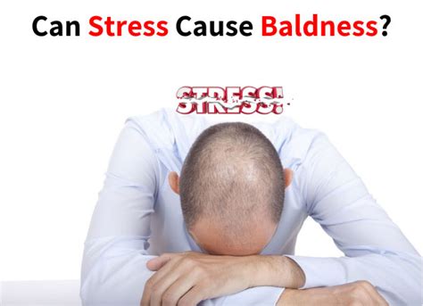 Do you live in constant fear of losing your hair? Can Stress Cause Baldness - Hair Loss Part 5 | Dr. Sam Robbins